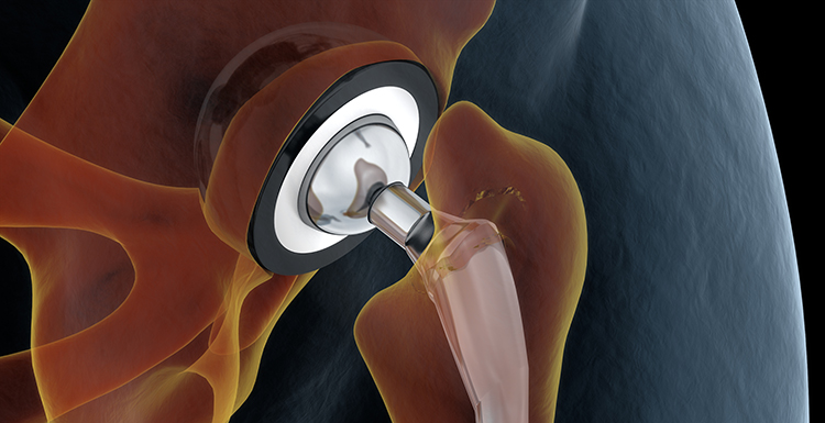 What Can I Do If I Am Injured Because of a Medical Device Error?